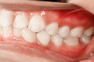 Patients are up to three times more likely to experience COVID-19 complications if they suffer from gum disease